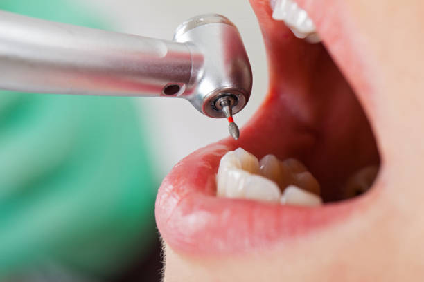 Best Emergency Tooth Extraction in Spanish Fork, UT